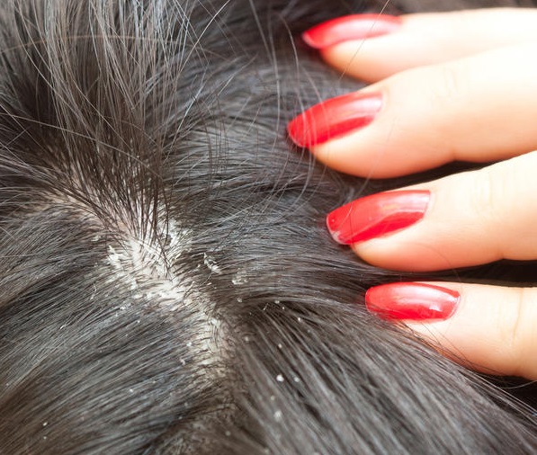 Homemade Remedies To Get Rid Of Dandruff